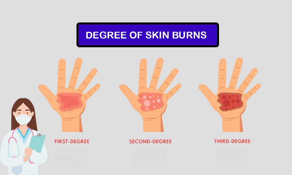 What is the Difference Between First, Second, and Third-Degree Burns?