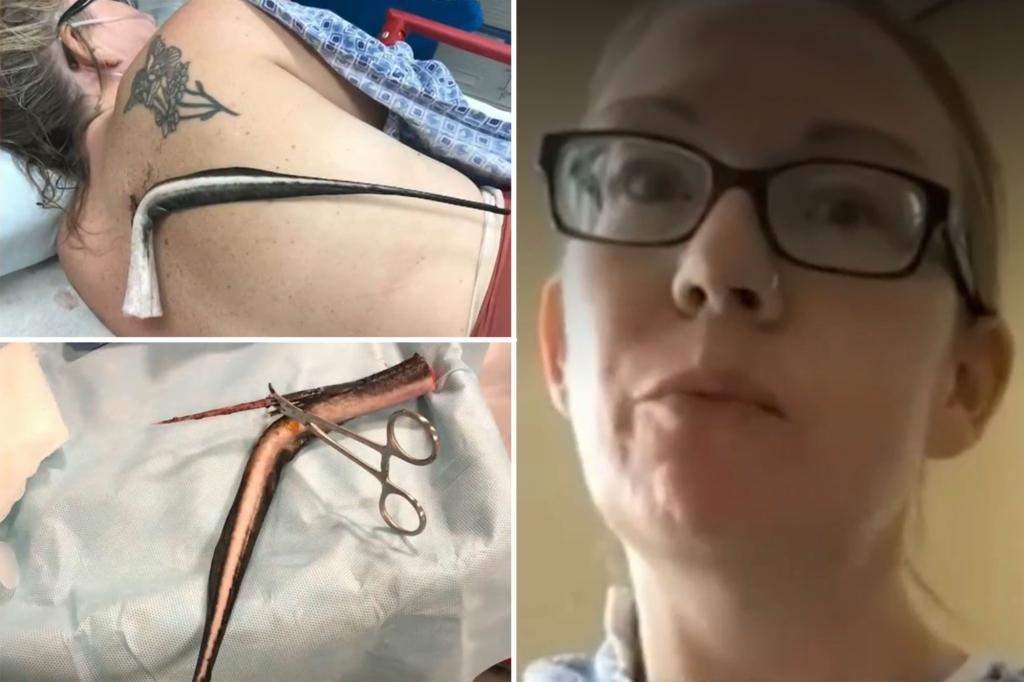Florida woman impaled by ‘super painful’ venomous stingray, missing her lungs by an inch