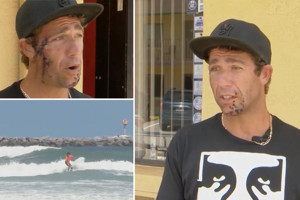 Surfer shows off gnarly injuries from shark bite to the face