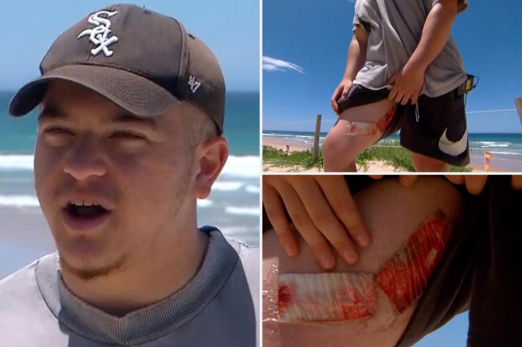 Australian comes terrifyingly close to death after shark bites leg — inches from major artery