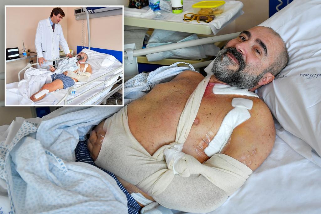 Italian man may regain use of hand after breakthrough nerve transfer from amputated leg