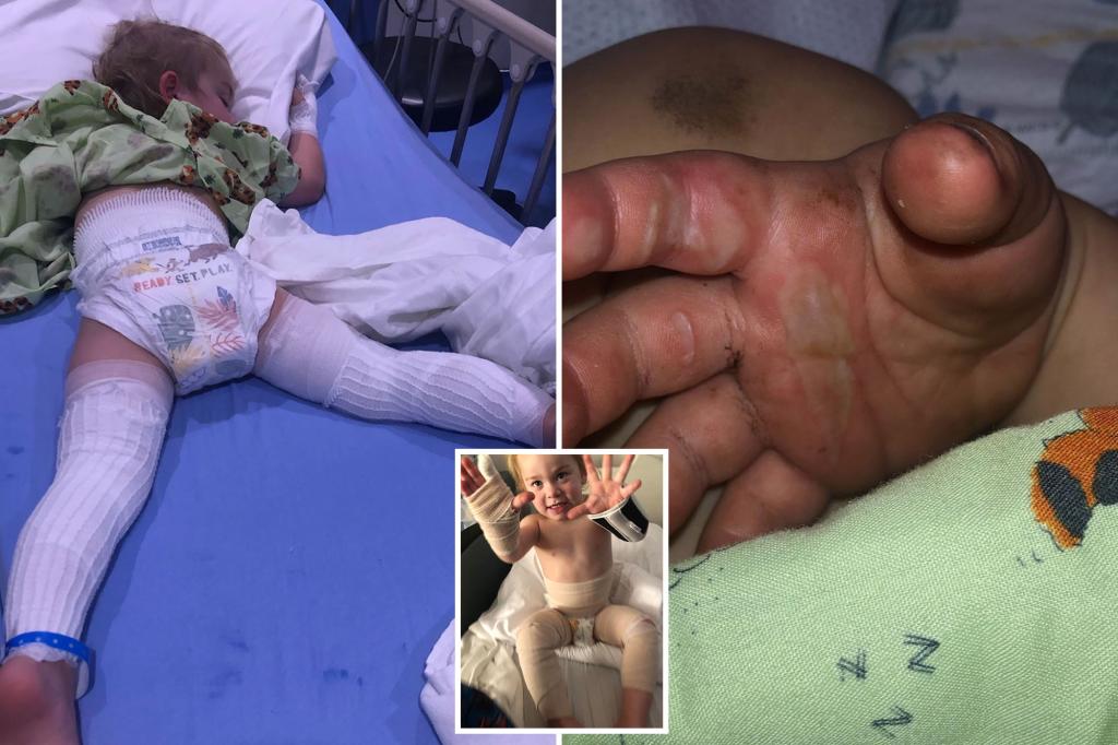 Florida boy, 2, suffers severe burns in fall into fire pit during camping trip