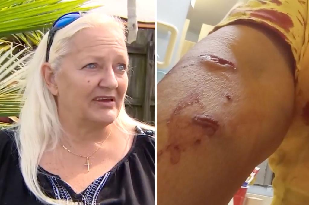 Florida woman injured while saving dog in harrowing alligator attack