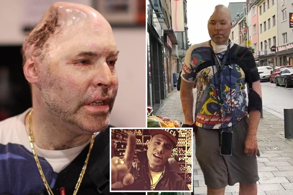 Rapper who lost half his skull in ‘Nazi gold’ drug lab explosion possibly facing prison: ‘Biggest mistake of my life’